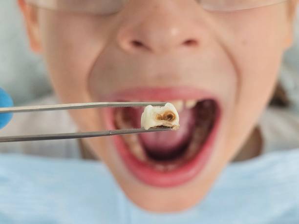 Best Emergency Tooth Extraction in Rio Linda, CA
