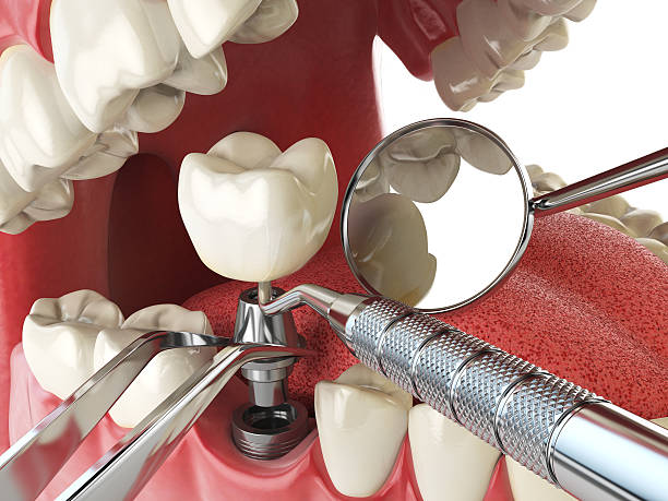 Best Emergency Dental Care for Broken or Chipped Teeth in Rio Linda, CA